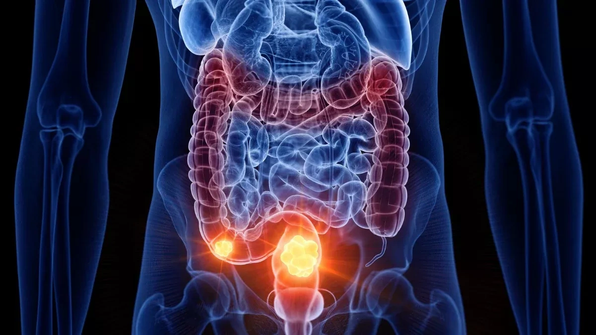 Why one cancer type keeps spreading among young people while others decline