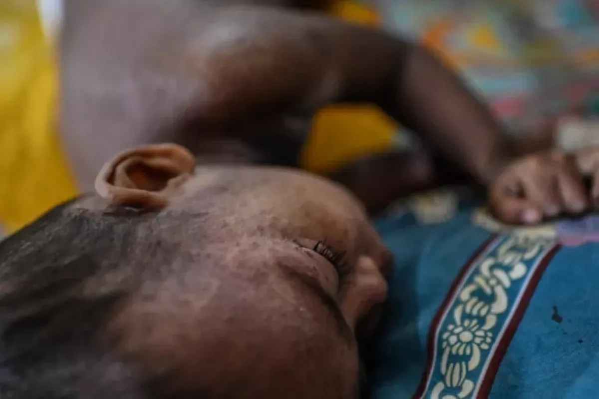 Why did Bangladesh’s record measles vaccine drive fail to stop 1,000 deaths?