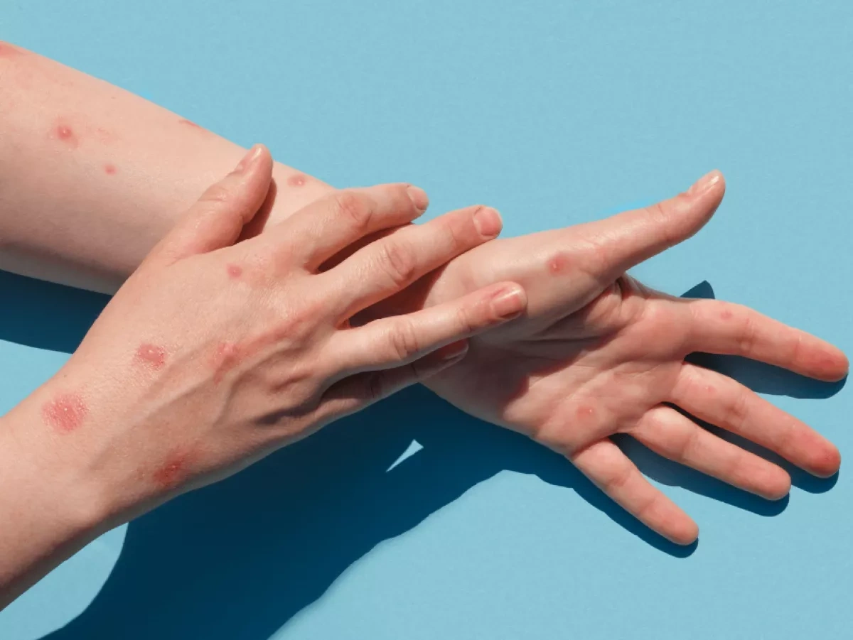 Media: Two monkeypox cases reported in Moscow region